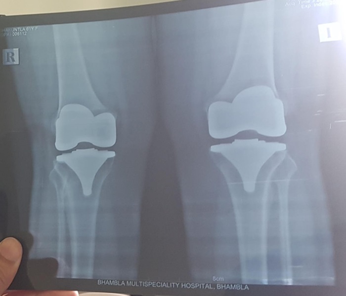 Robotic total Knee Replacement in Mandi HP